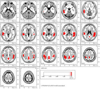 Gallery Photo of qEEG Brain Mapping shows how well is your brain working compared to others in your age group.
