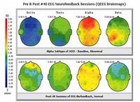 Gallery Photo of Too little power in low frequencies and too much activity in the frontal alpha waves are a type of ADHD.  Neurofeedback corrects this imbalance.