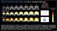 Gallery Photo of Guadagnin V, et al. Deep Transcranial Magnetic Stimulation: Modeling of Different Coil Configurations. IEEE Trans Biomed Eng. 2016; 63:1543-50.