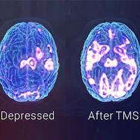 Gallery Photo of A depressed Brain vs A Non-Depressed Brain