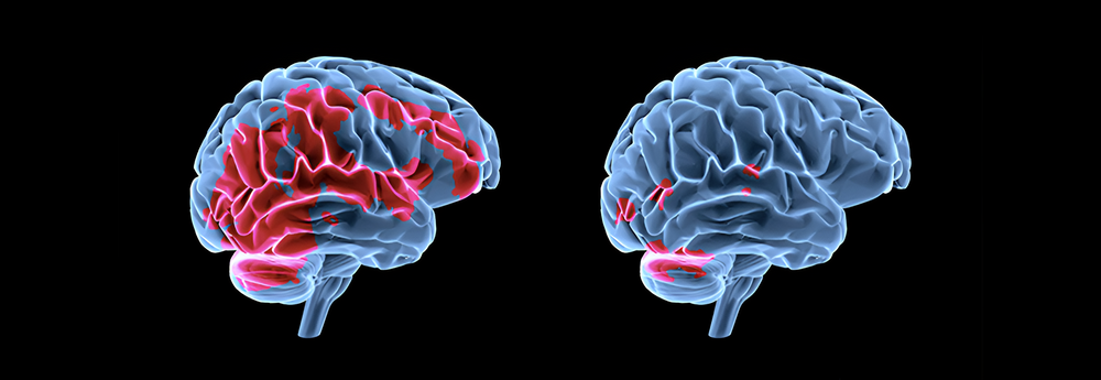 The left image shows woman with PTSD. The right image is the same woman after four 90-minute sessions of EMDR. Red areas are overactivity in the brain
