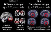 Gallery Photo of PET brain scans showing physical differences in brain activity after SGB treatment. http://bit.ly/2rJtJFo